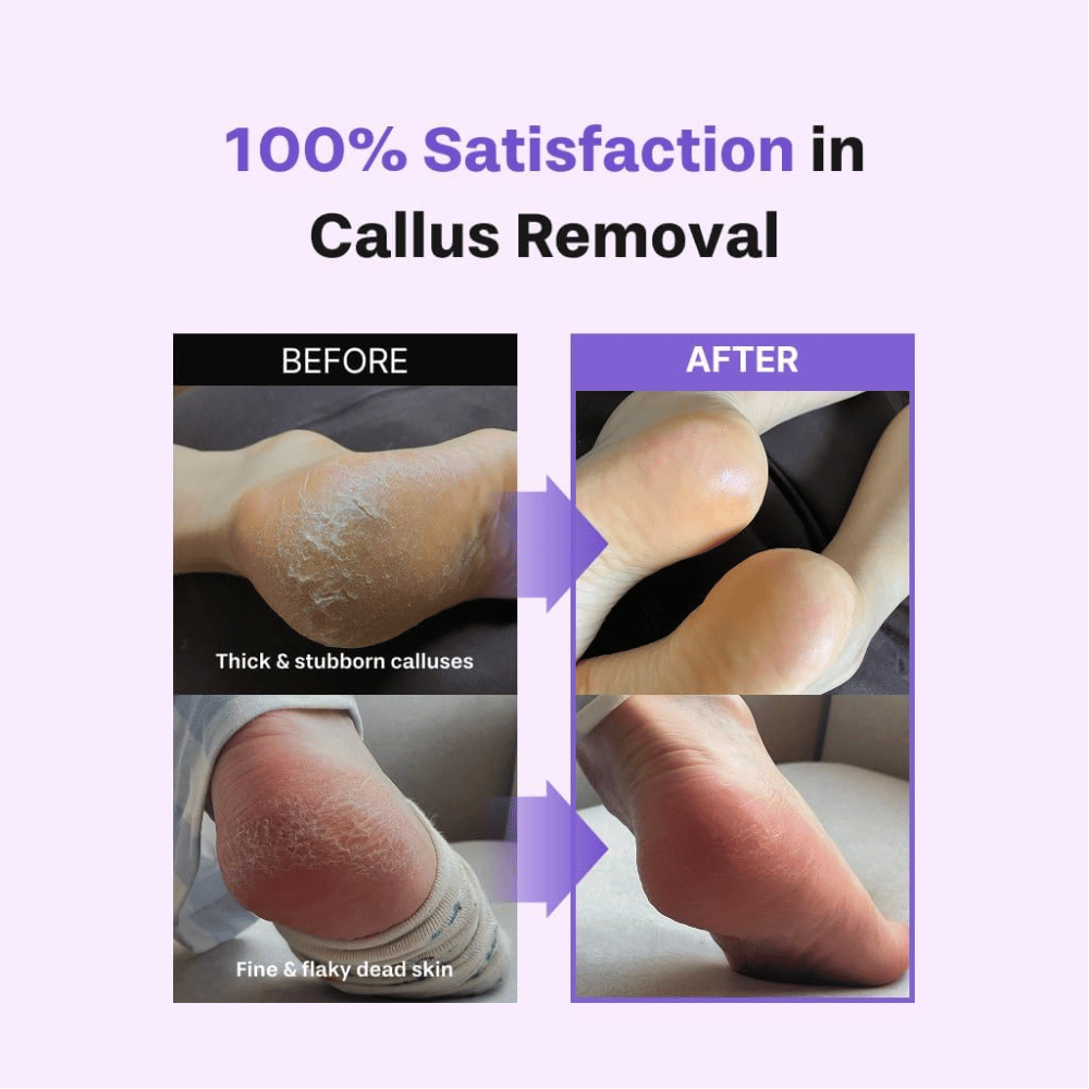 Prima e dopo l’uso di BAREN Foot Callus Eraser Home Set su piedi secchi, pelle morta e callosità